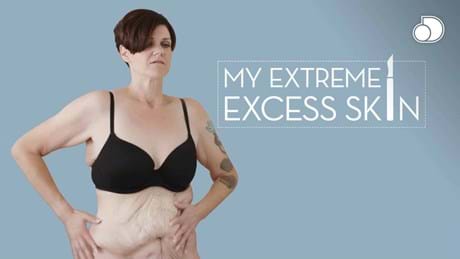My Extreme Excess Skin S2 2017